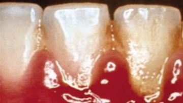 7 สาเหตุ เหงือกบวม วิธีรักษาและคำแนะนำเบื้องต้น - Skt Dental Center