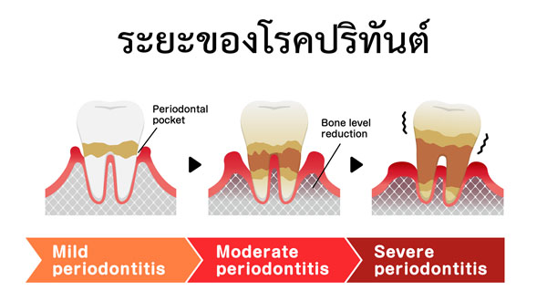 โรคปริทันต์