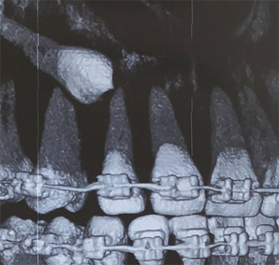 จัดฟันดึงฟันฝัง