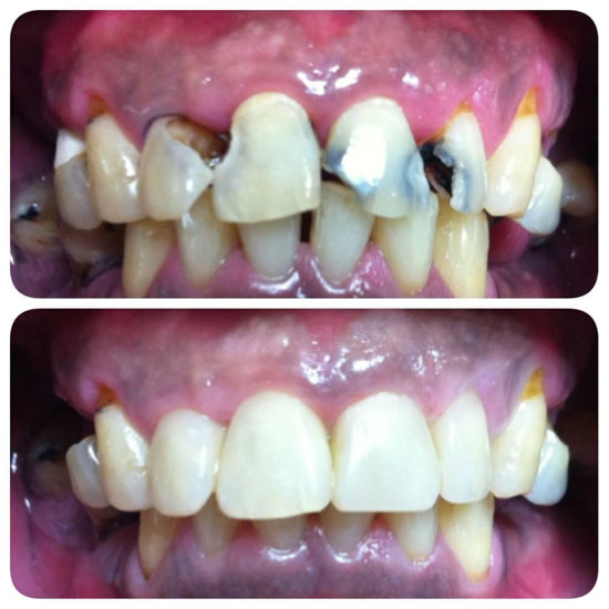 อุดฟันหน้าราคา