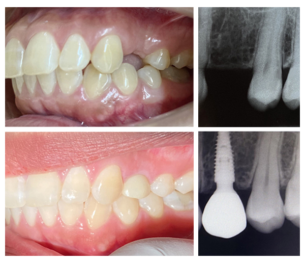 รากฟันเทียม Neodent