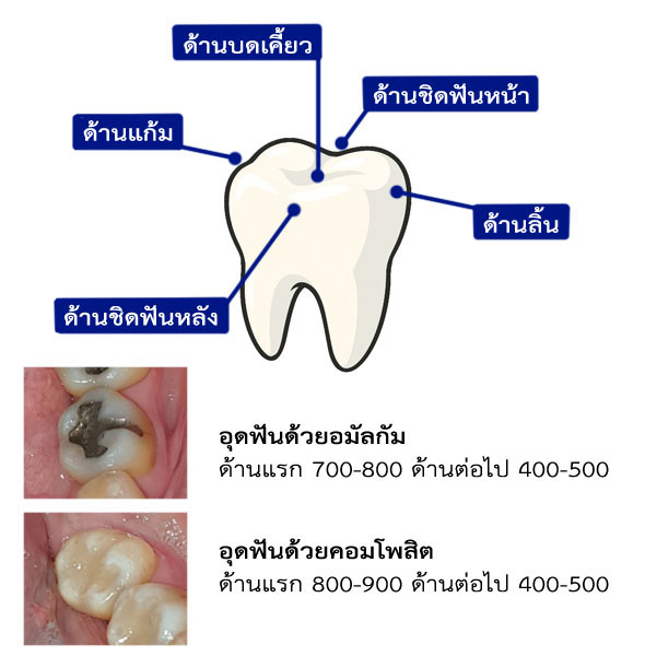 อุดฟันราคา