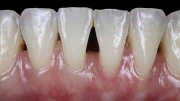 เหงือกร่น