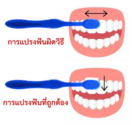 แปรงฟันผิดวิธี