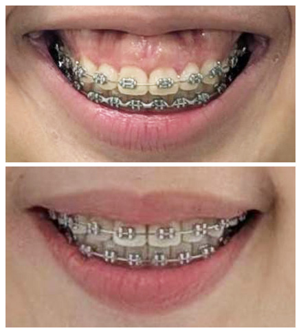 gummy smile