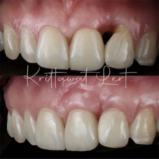 ปลูกเหงือกเฉพาะตำแหน่ง