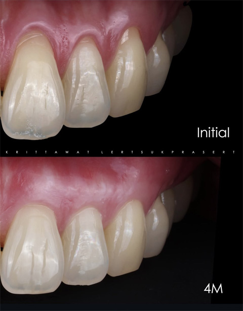 ปลูกเหงือก