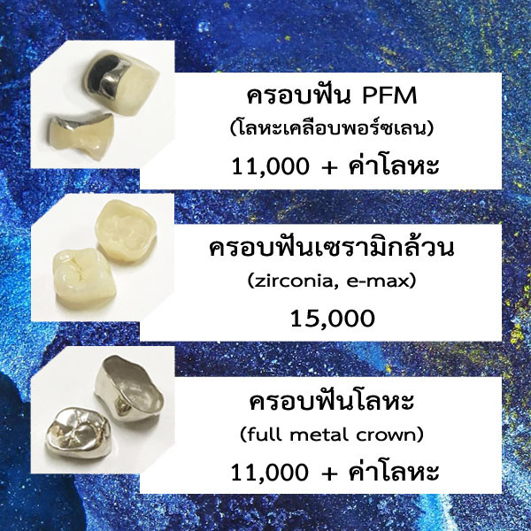 ครอบฟันราคา