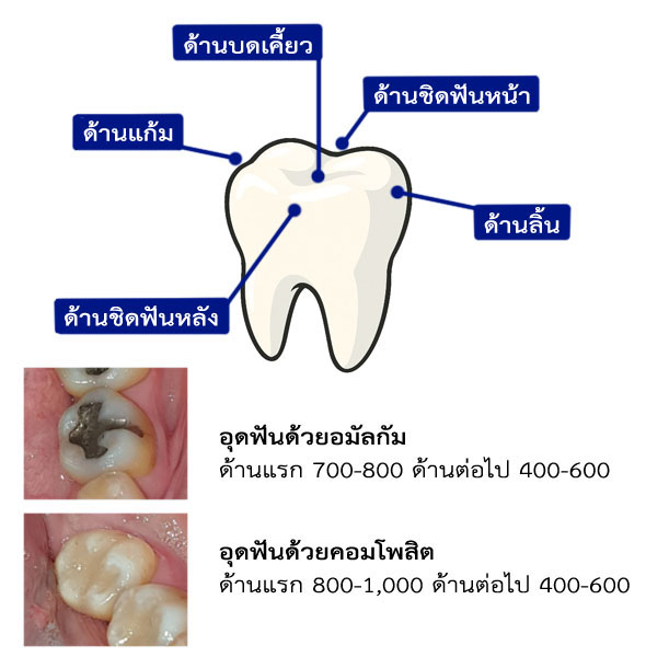 อุดฟันราคา