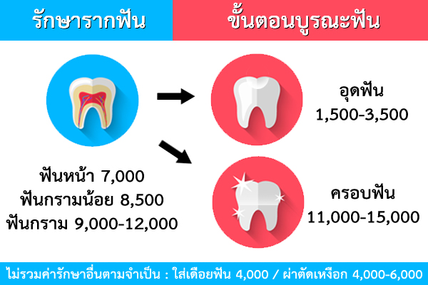 รักษารากฟันราคา