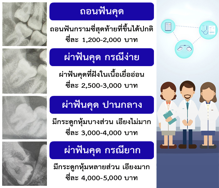 ผ่าฟันคุดราคา