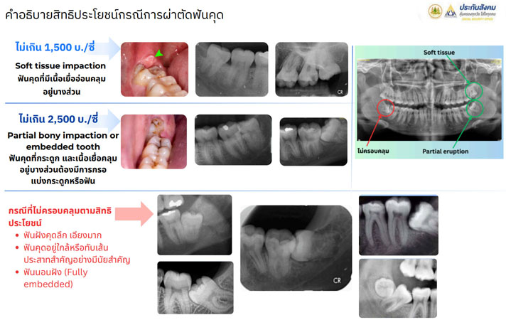 ผ่าฟันคุดประกันสังคม