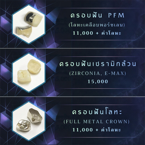 ครอบฟัน ราคา
